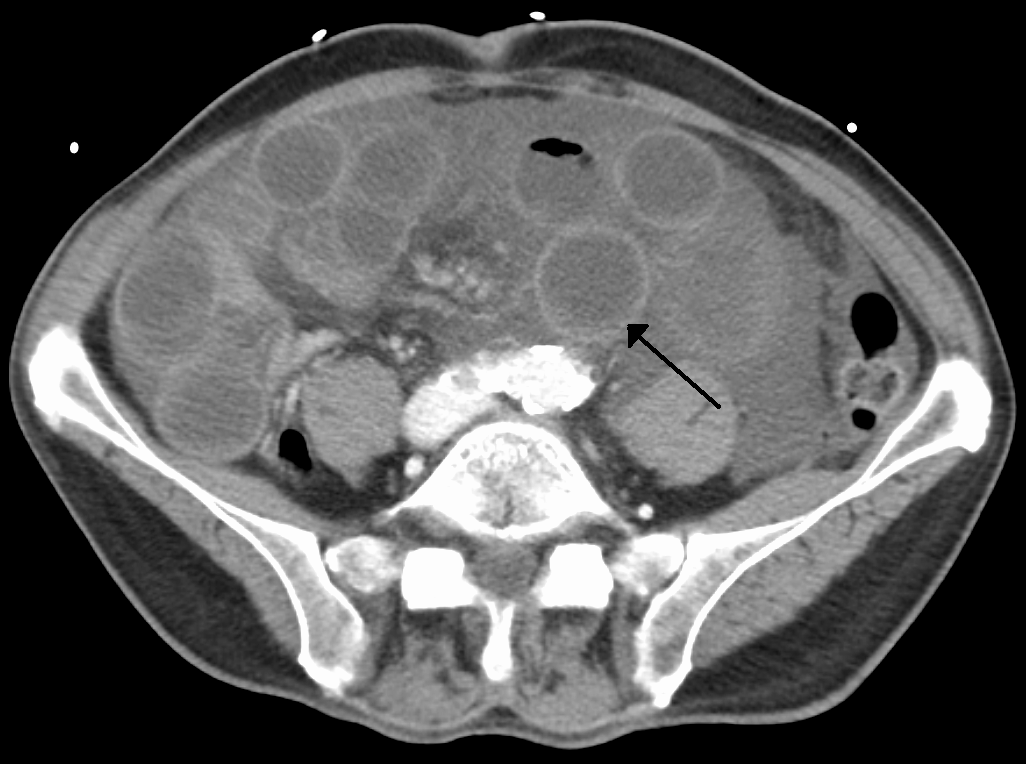 上腸間膜静脈血栓症による腸管虚血。拡張と壁肥厚を伴う腸管を示す。