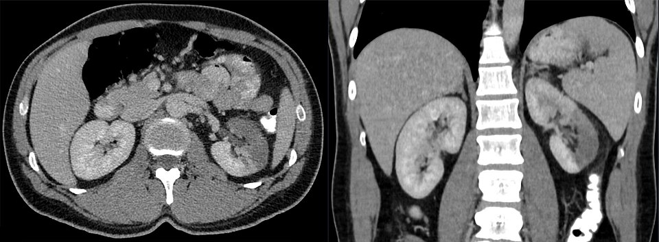 造影CTで左腎の部分梗塞を示す。左上腹部から側腹部の痛みで発症。