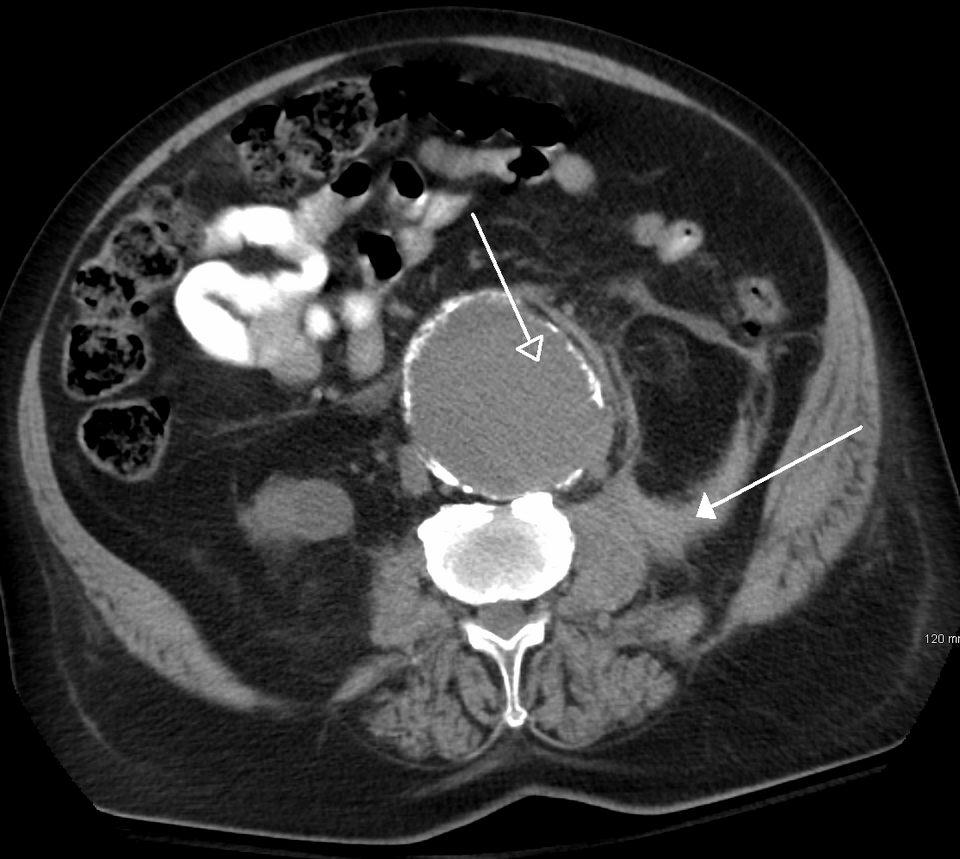 腹部大動脈瘤破裂のCT。拡張した大動脈と周囲の後腹膜血腫を認める。