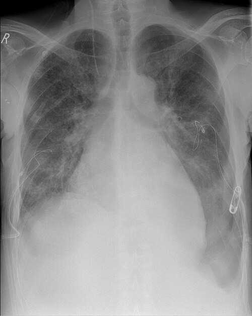 仰臥位胸部X線で左外側肋骨横隔膜角が深く透亮化するdeep sulcus signを認める。両側に胸腔ドレーンがある。