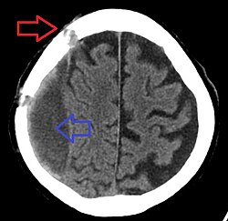穿頭術後の慢性硬膜下血腫。赤矢印は穿頭孔、青矢印は残存する慢性硬膜下血腫を示す。