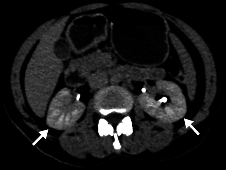 急性腎盂腎炎の造影CT。腎実質に帯状の造影差を示すstriated nephrogram。