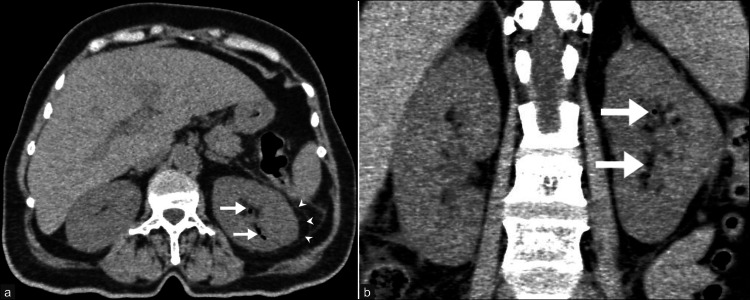 早期の気腫性腎盂腎炎。左腎実質・腎盂腎杯内のガスを軸位像と冠状断で示す。