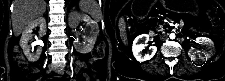多発腎膿瘍を伴う急性腎盂腎炎。遅延相CTで辺縁造影を伴う病変と下極の破裂を示す。原図のbは著者による明るさ調整画像。
