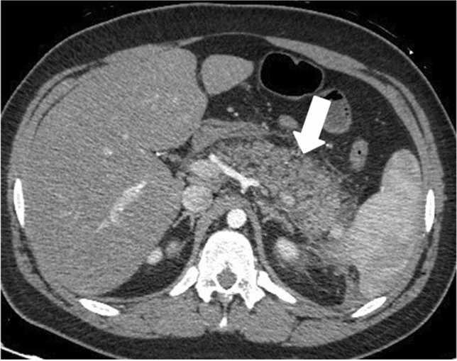 間質性浮腫性急性膵炎。膵腫大と輪郭不明瞭化があり、造影効果は保たれている。