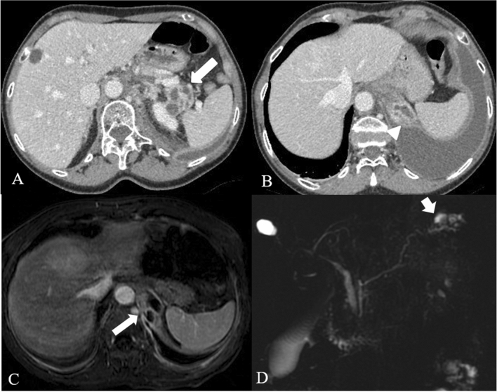 壊死性膵炎に伴う胸腔への瘻孔と胸水。CT、造影MRI、MRCPによる比較。