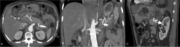 壊死性膵炎に合併した脾動脈仮性動脈瘤。動脈相CTのMIP・多断面再構成で示す。