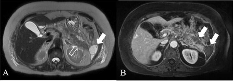 Walled-off necrosisのMRI。T2強調像と造影T1強調像で、被包化され内部不均一な膵・膵周囲貯留を示す。